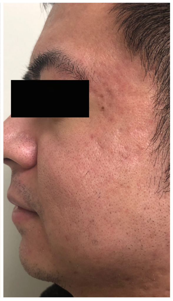Damaged Skin Before and After Lantry Aesthetic & Skin Care Center