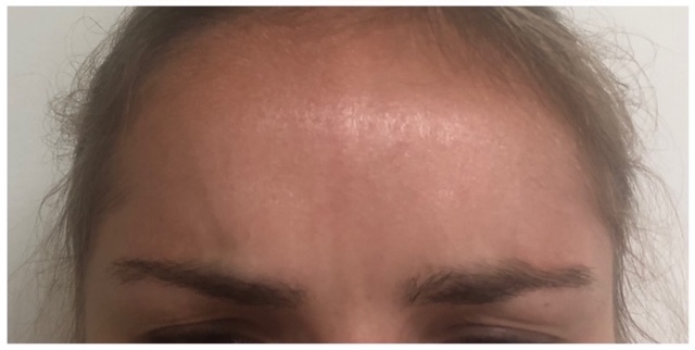 botox before and after for glabella