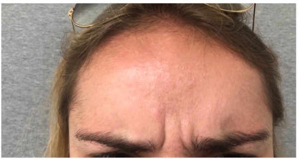 botox before and after for glabella