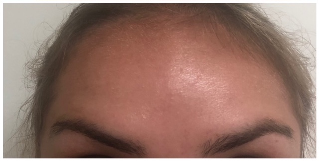 botox before and after for glabella