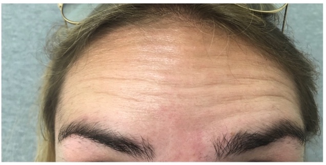 botox before and after for glabella