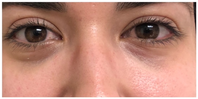 eyes before and after