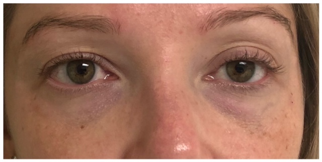 eyes before and after