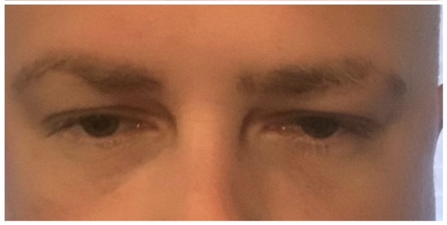 eyes before and after