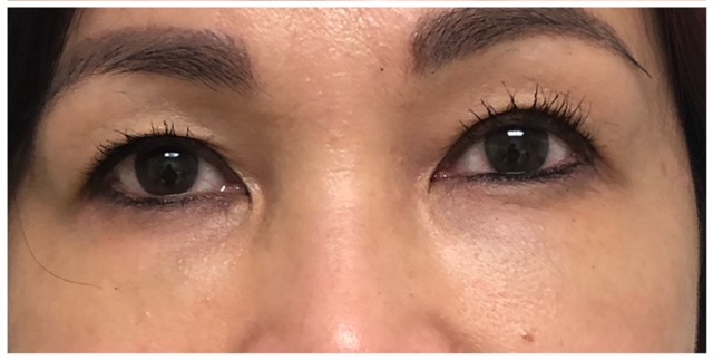 eyes before and after